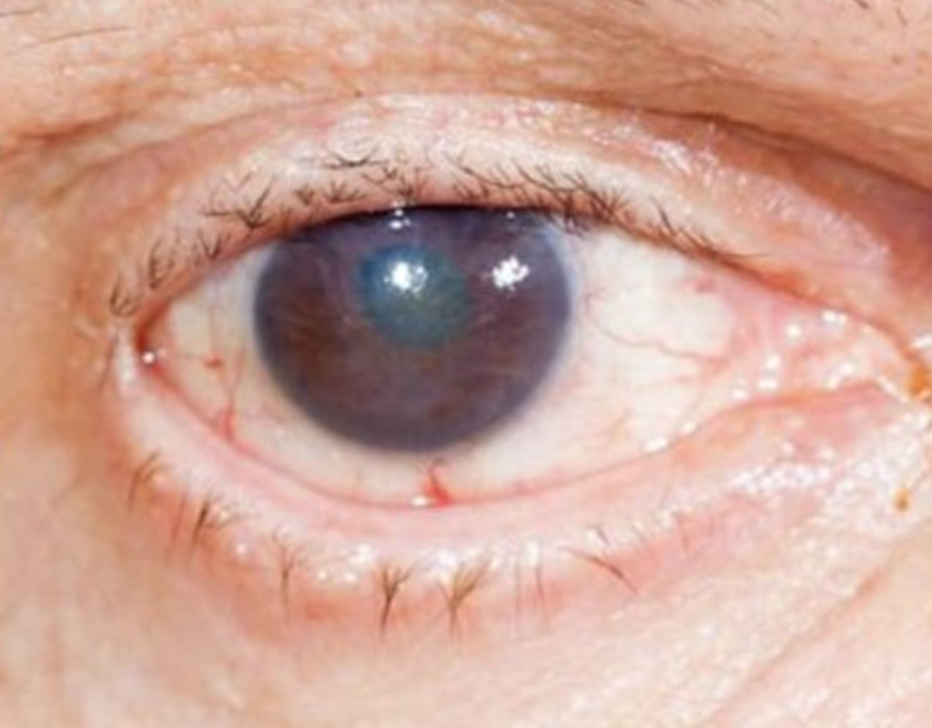 Close-up of an eye showing changes caused by diabetic retinopathy.
