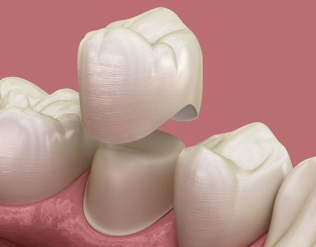 Digital illustration of a dental crown being placed over a prepared tooth.