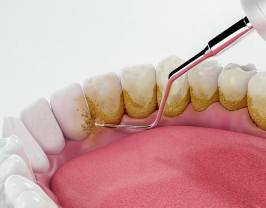 Close-up illustration of dental scaling removing tartar from teeth.