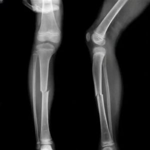 X-ray of a lower leg showing a fracture in the tibia.