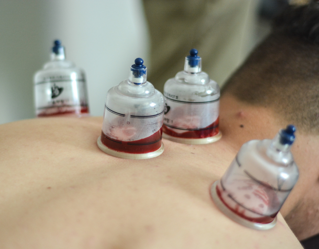 Close-up of hijama (wet cupping) therapy with blood collected in cups on a patient’s back.