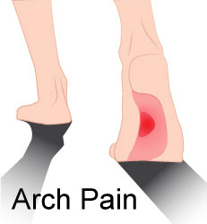 Causes of Arch Pain and It’s Treatment