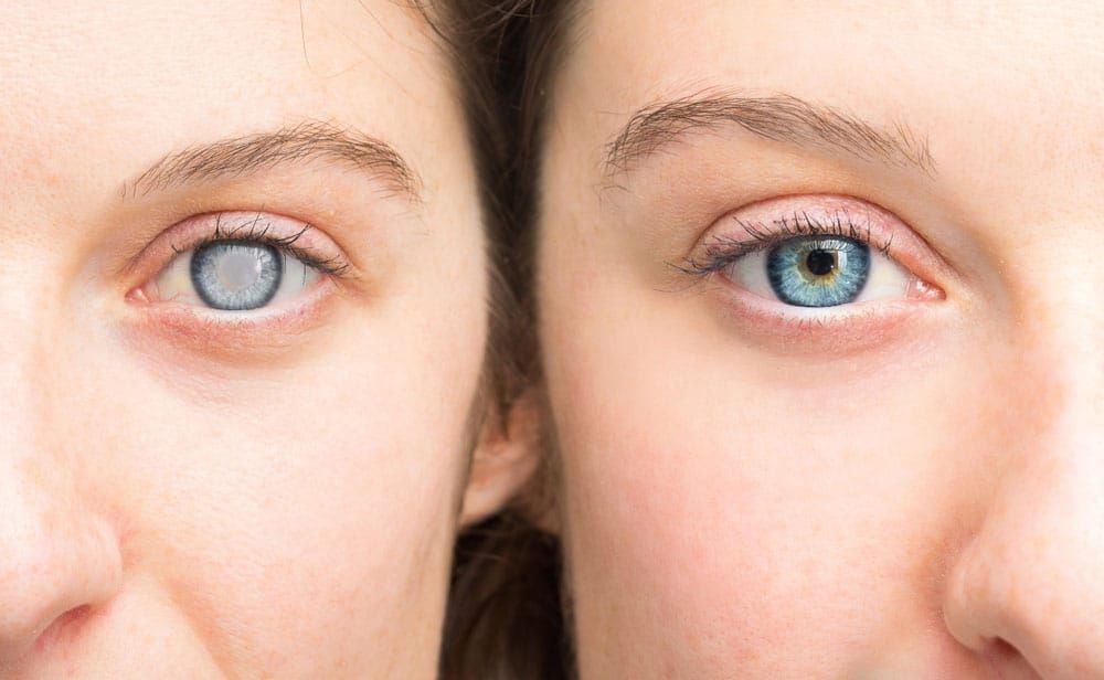 Side-by-side close-up of two human eyes; the left eye shows a cloudy lens due to a cataract, while the right eye appears healthy and clear.